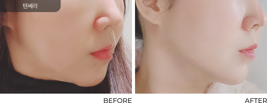 전후사진
