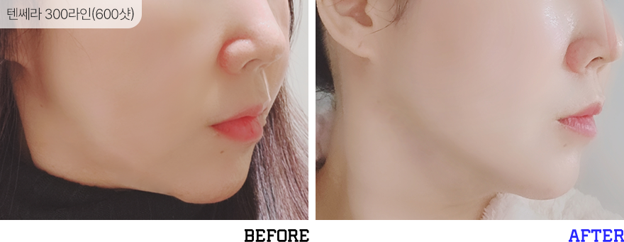 전후사진