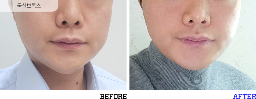 전후사진