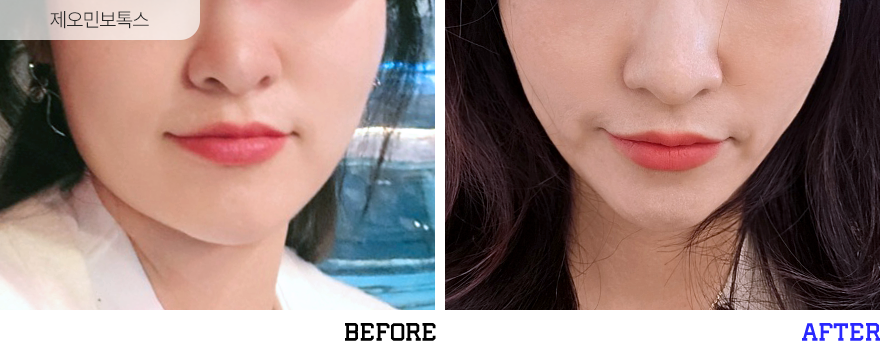 전후사진